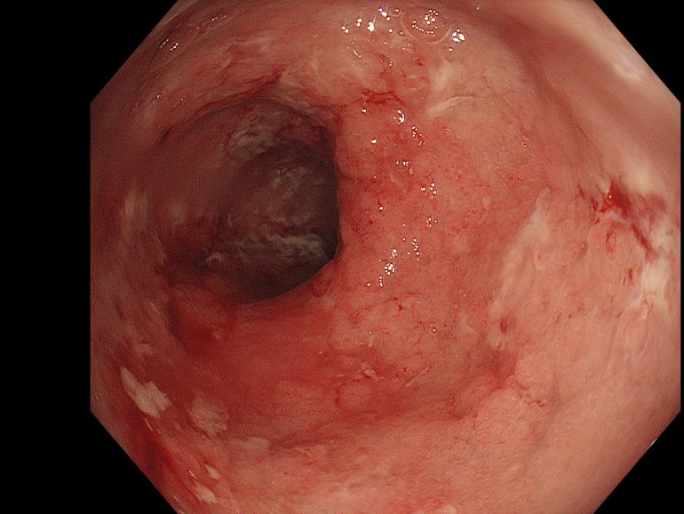 潰瘍性大腸炎