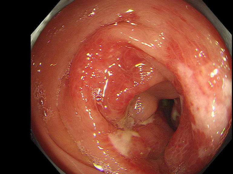 虚血性腸炎