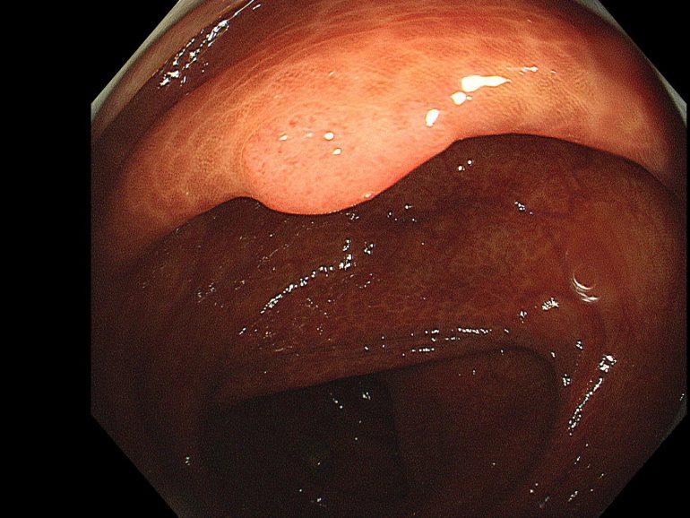大腸ポリープ