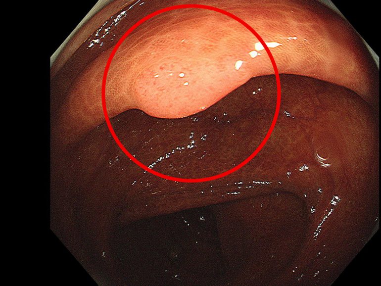 大腸ポリープの内視鏡的切除手術