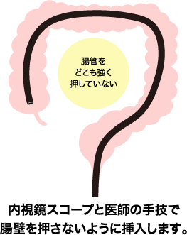 内視鏡スコープと医師の手技で腸壁を押さないように挿入します