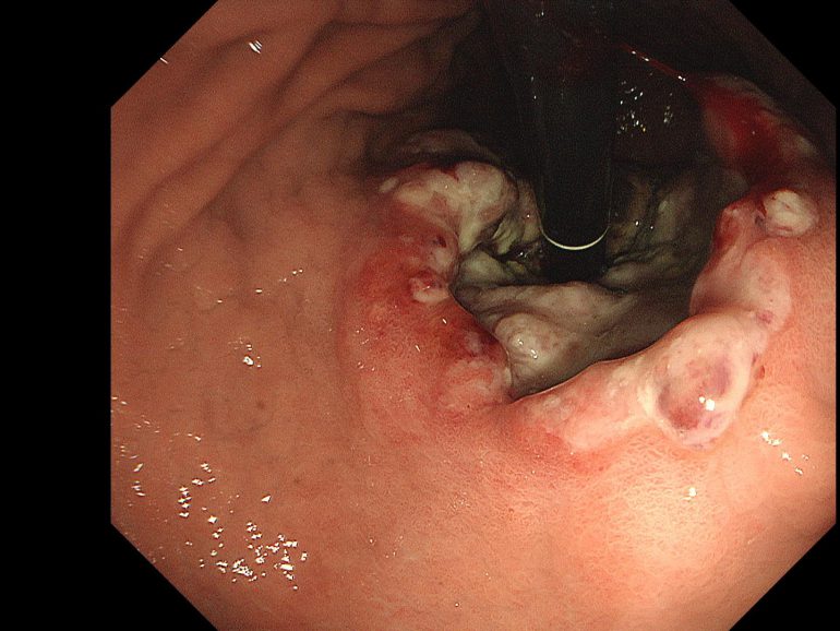食道・胃接合部がん