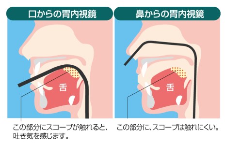 経鼻内視鏡の特徴