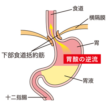 食道 炎 ストレス 逆流 性